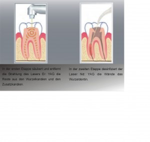 endo de